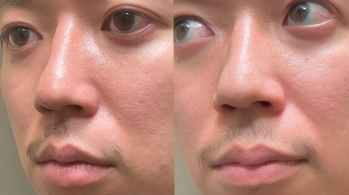 Duoの黒を試して1ヶ月 いちご鼻は改善された 画像加工なし